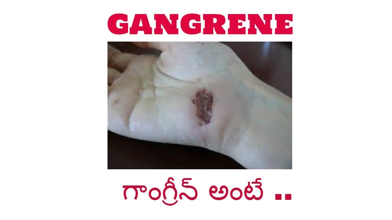 the beginners guide to gangreneగాంగ్రీన్ అంటే ఏమిటి YouTube