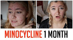 1 MONTH ON MINOCYCLINE UPDATE | HOW I CLEARED MY ACNE
