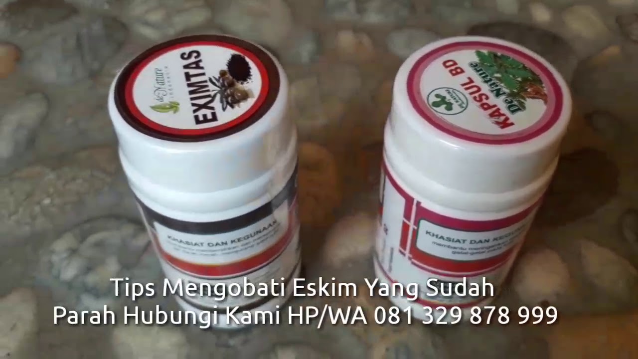 cara mengobati eksim yang ampuh #caramengobatieksim #obateksim #