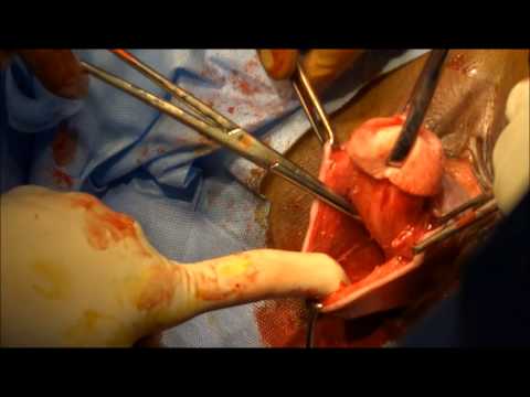 Vaginal Hysterectomy for prolapse uterus ▶1:06 