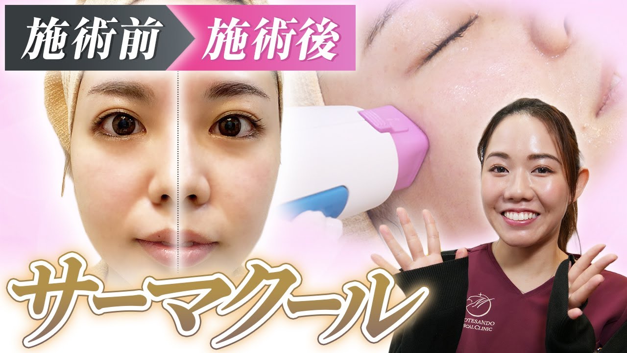 リフトアップに効果抜群】痛いけどすごく引き締まる、たるみの美容治療