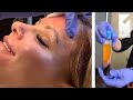 Microneedling with prp at med 1 aesthetics with dr nicole oneill