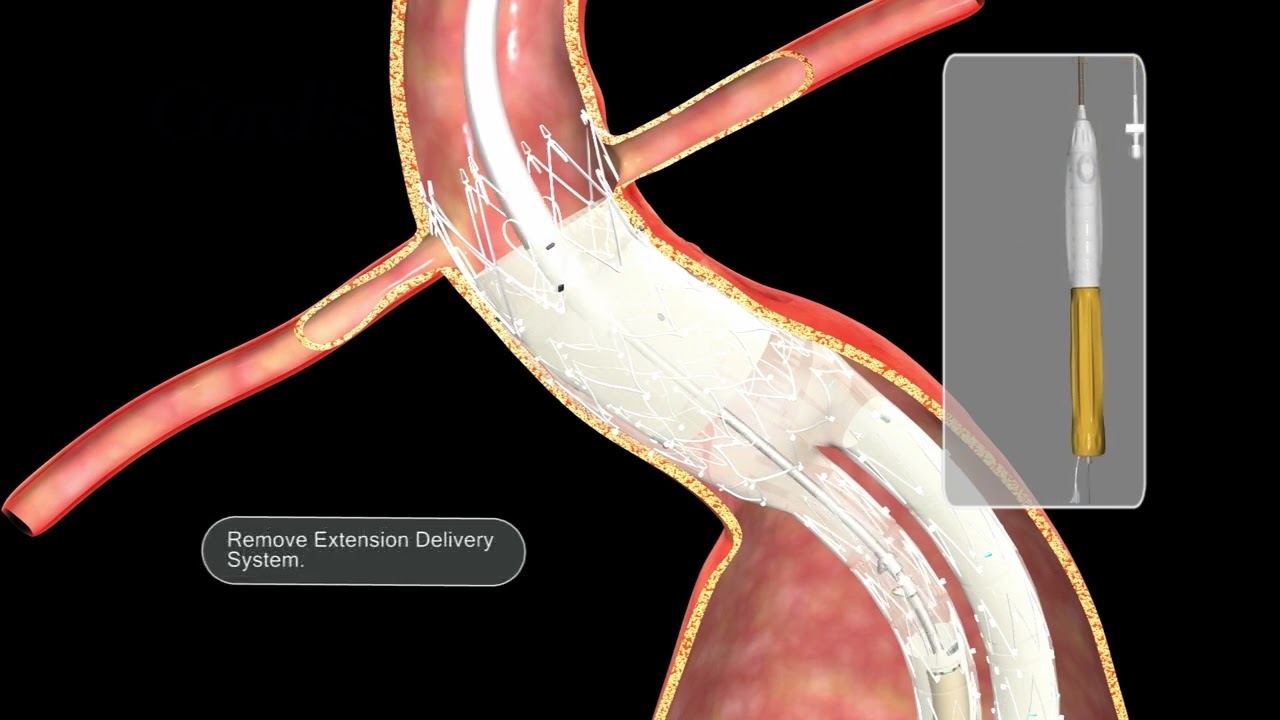 INCRAFT AAA Stent Graft System Aortic Extension Deployment Guide YouTube INCRAFT AAA Stent Graft System Aortic Extension Deployment Guide YouTube