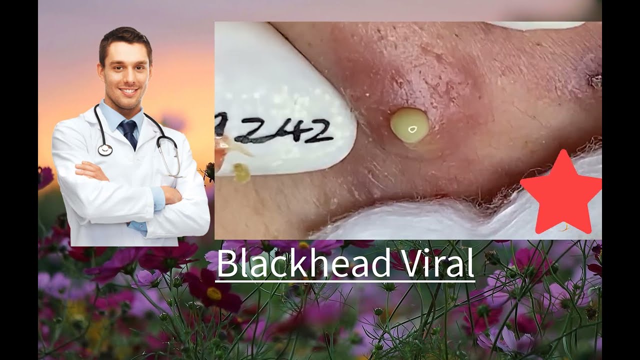 cystic acne blackhead and whitehead removal 낭포성 여드름 블랙헤드 및 화이트헤드 제거