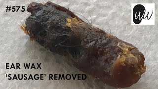 575 - Ear Wax 'Sausage' Removed