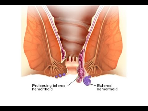 Treatment for hemorrhoids (almoranas) [ENG SUB]