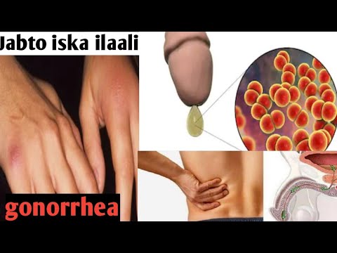 Waa Maxay Gonorrhea| Jabto| Lab diagnosis| Waa maxay jabto