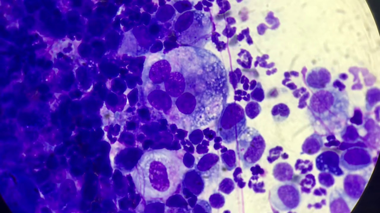 Multinucleated Giant Cell Youtube