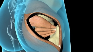 Arthroplastie totale de hanche