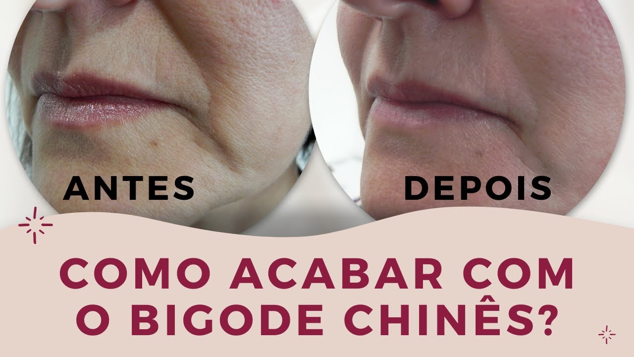Como ACABAR Com o Bigode Chinês? Conheça os Adesivos Antissinais ...