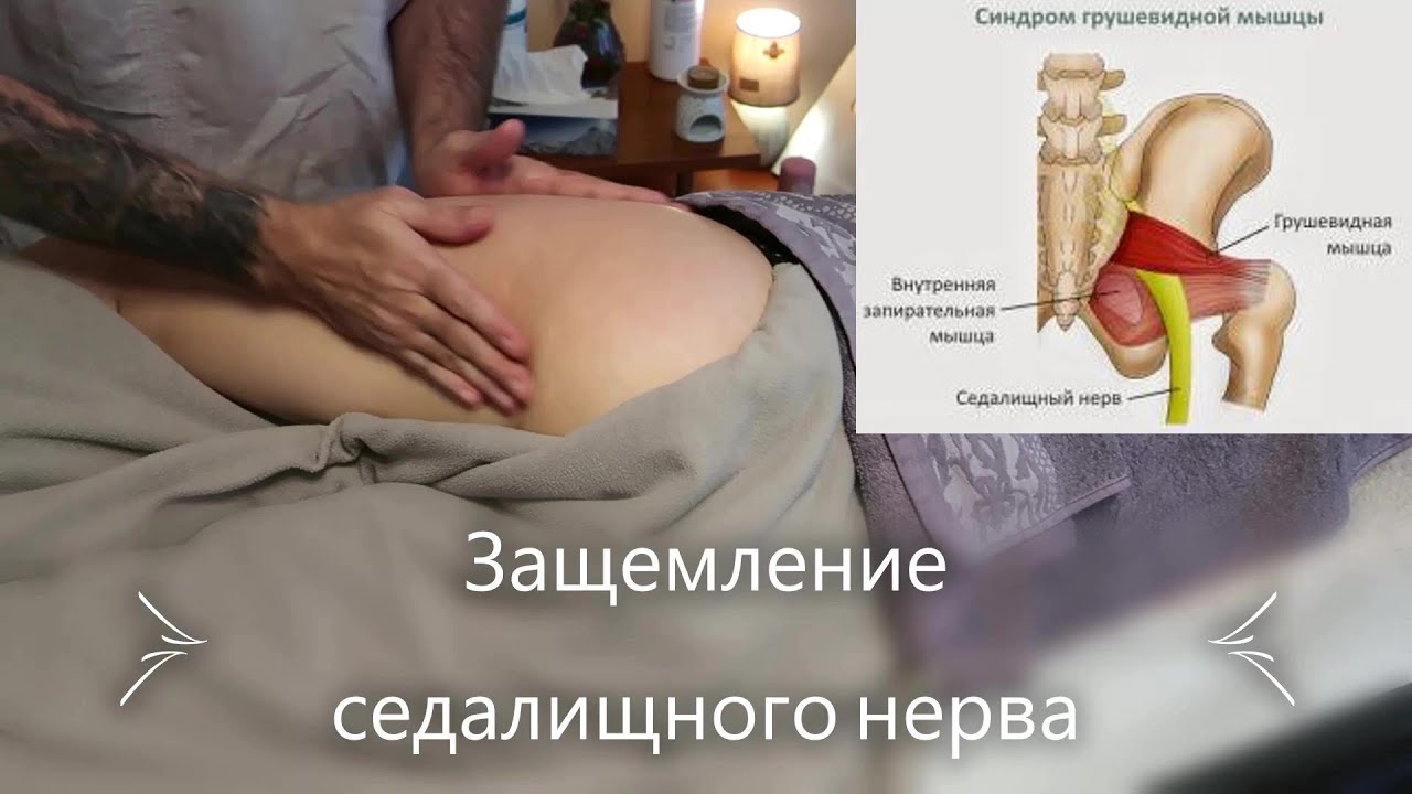 Как вылечить защемление седалищного нерва