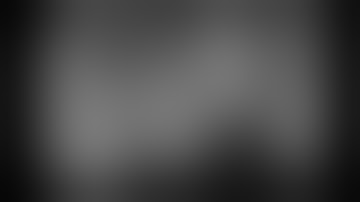 Implant + sinus lift + Gbr & Ct graft with PRF membrane. Dr. Omid Termechi