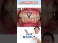 【大きな前歯がイヤ…】神経残すセラミックで前歯を小さく!? #shorts