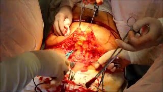 Абдоминопластика с герниопластикой (видео содержит хирургическую операцию)(Пациентка 56 лет с невправимой пупочной грыжей, вправимой послеоперационной вентральной грыжей и 