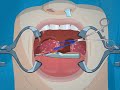 Operate now  tonsil surgery  play tonsil surgery games online