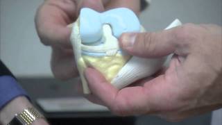 Penn Joint Replacement Service -- Overview by Dr. Craig Israelite