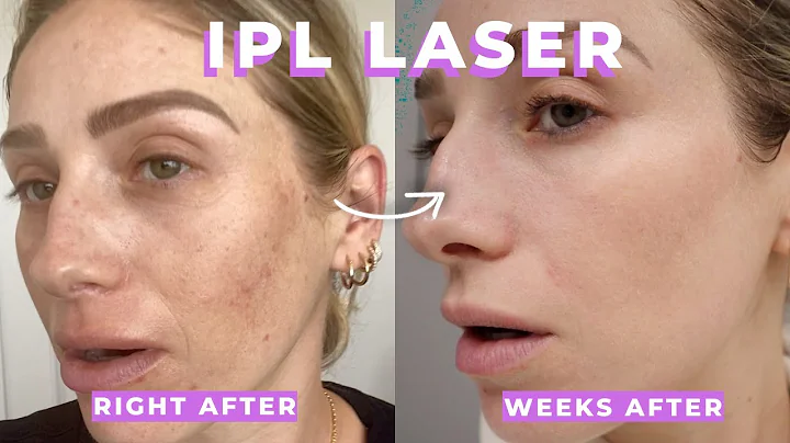 IPL + CLEAR AND BRILLIANT LASER REVIEW | What are they? Are they painful? Is it worth it?