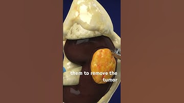 How Robotic Partial Nephrectomy Surgery is Done? (3D Animation) #how #robotics #surgery #technology