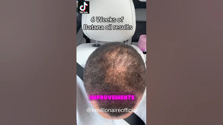 🤔 WHY IS EVERYONE TALKING ABOUT THIS OIL FOR HAIR GROWTH? #alopecia #CCCA #batanaoil