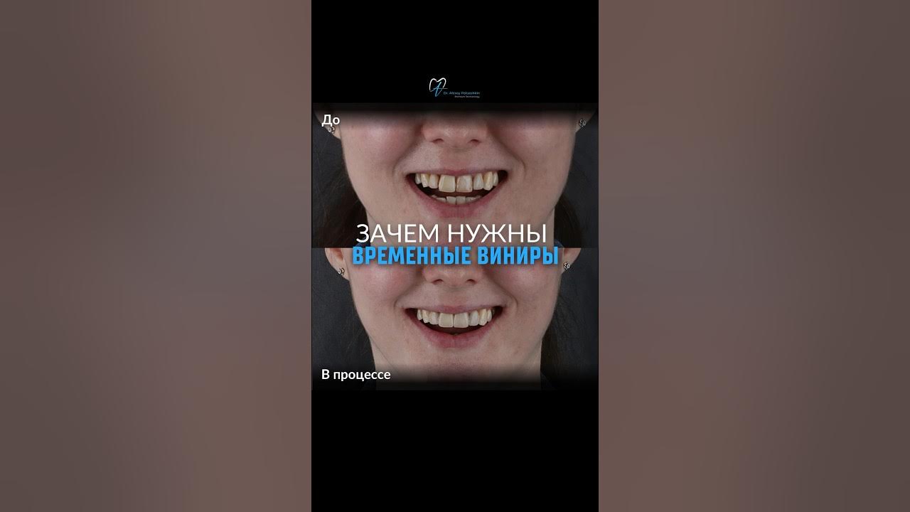 Временные виниры #стоматолог #виниры - YouTube