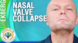 Collapsed Nasal Passage / Nasal Valve Collapse