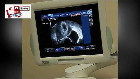 GENERAL ULTRASOUND - ESAOTE - MYLAB50 XVISION