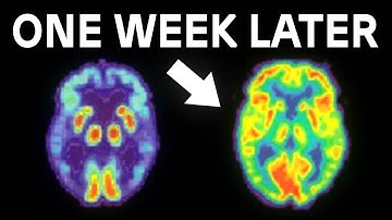 How I Cured My Brain Fog (Fastest Method)