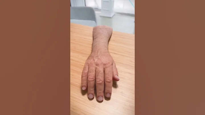 Silicone Hand Prosthesis Fit! #luxmed #prosthesisfit #prosthetics #silicone #siliconehand