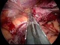 Laparoscopic Vertical Gastrectomy