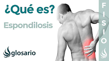 ¿Cuáles son las complicaciones de la espondilosis lumbar?