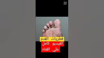 علاج فطريات وتينيا القدم واليد مابين الاصابع 