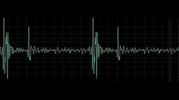 TIẾNG TIM BÌNH THƯỜNG | Dễ nghe, dễ phân biệt