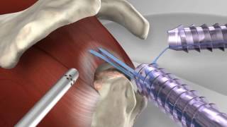 Knotless Rotator Cuff Repair with Arthrex® SpeedFix™