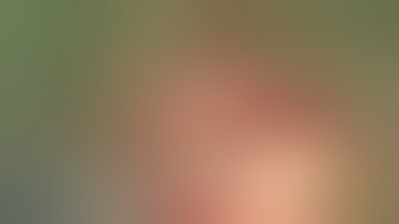 Missing Malleus, Incus & Stapes - Ossiculoplasty with Malleus Replacement Prosthesis & TORP