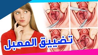 قبل وبعد عملية تضيق  المهبل