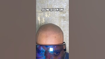 Second session scalp micropigmentation gives 50% results #scalpmicropigmentationindia #smp