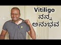 Vitiligo My Experience World Vitiligo Day ವಿಟಿಲ್‍ಗೋ-ತೊನ್ನು ಹಾಲ್ಚರ್ಮ ಬಿಳಿ ಮಚ್ಚೆ