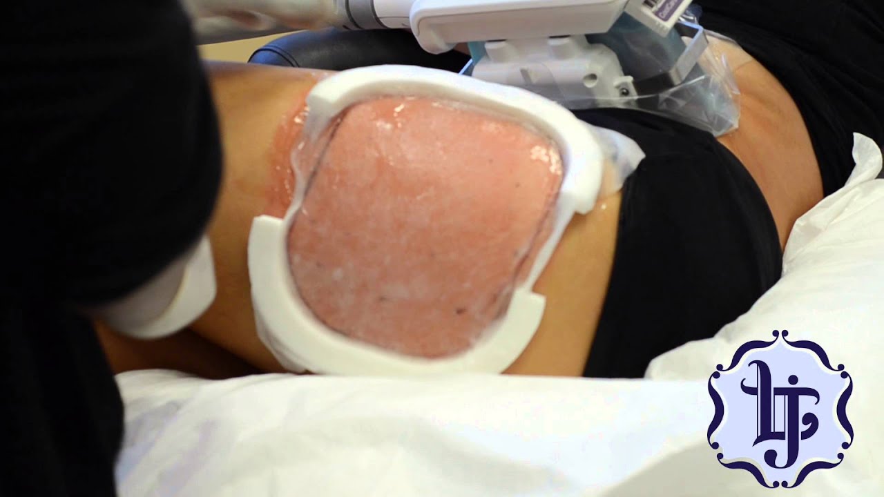 Introducing CoolSculpting's New CoolSmooth Pro