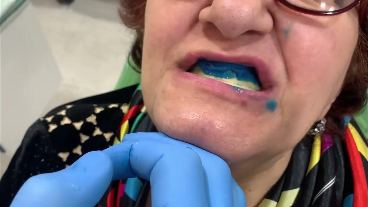 Custom, individual tray impression taking. Bite rim registration. Removable Dentures. YouTube