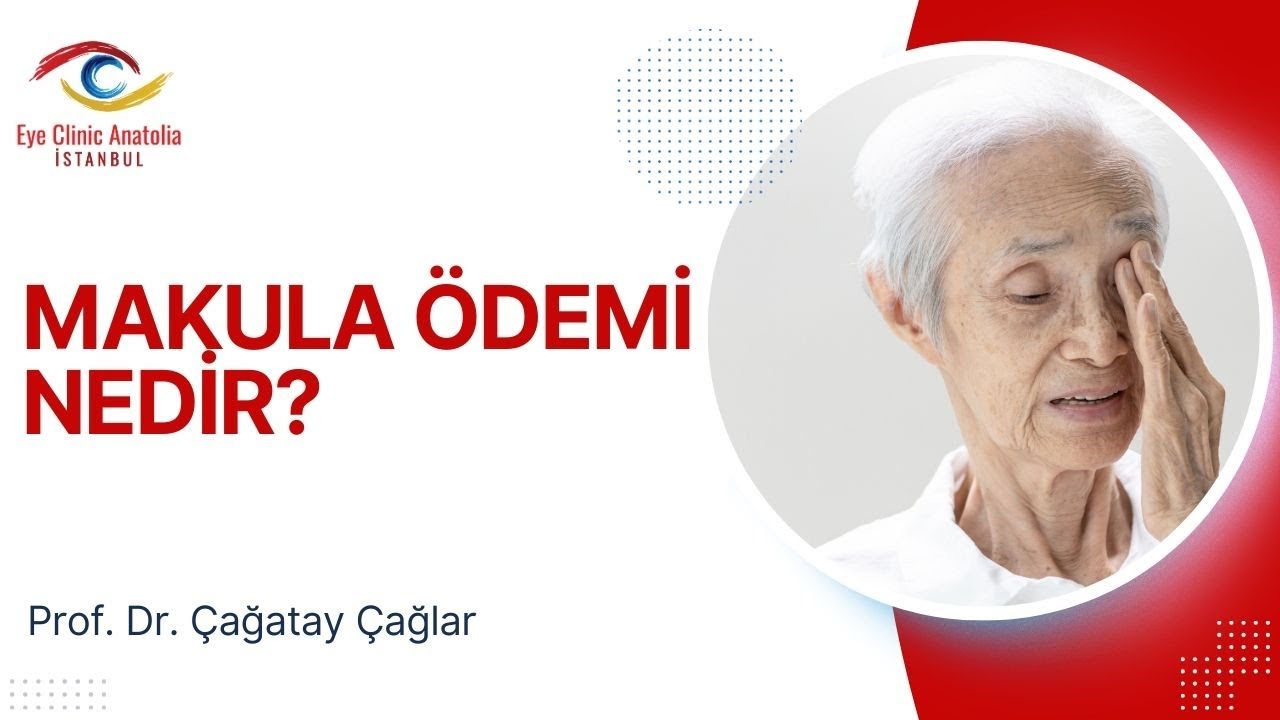Makula Ödemi Nedir? /  Dr. Çağatay Çağlar