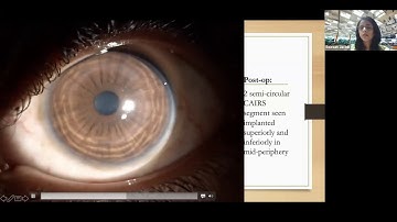 MANAGEMENT OF KERATOCONUS ROLE OF CAIRS y CACXL - DRA. SOOSAN JACOB