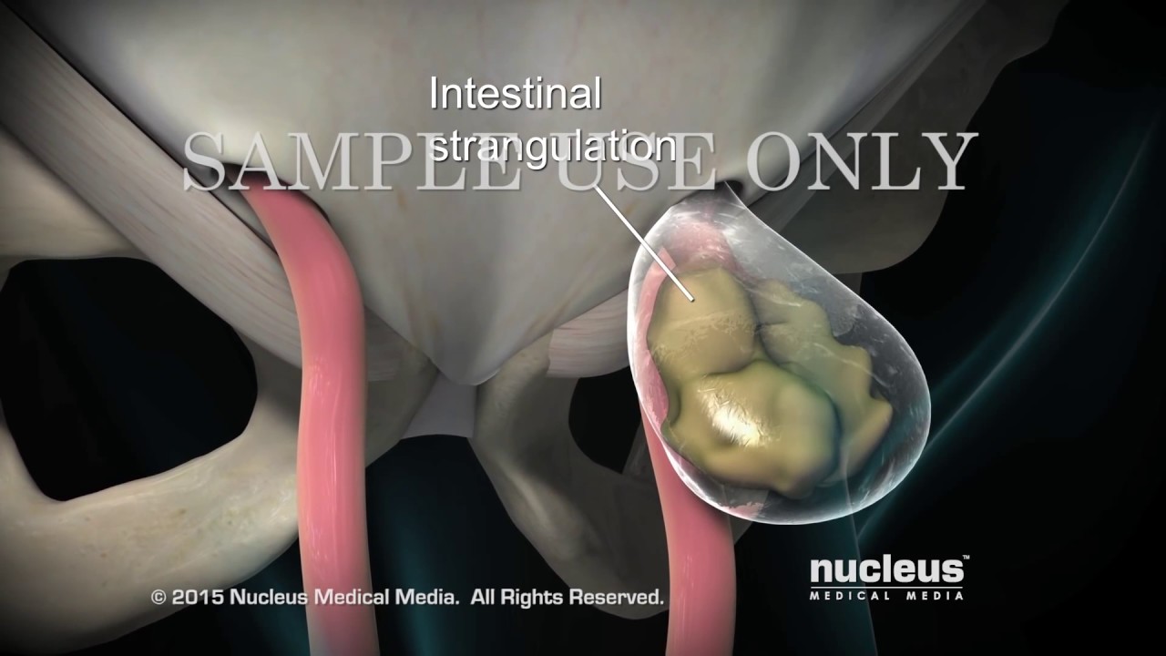 Total Extraperitoneal TEP Laparoscopic Inguinal Hernia Repair