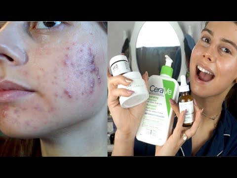 My SKINCARE ROUTINE! || WHAT I HAVE BEEN DOING TO GET RID OF MY ACNE (How I cleared my skin)