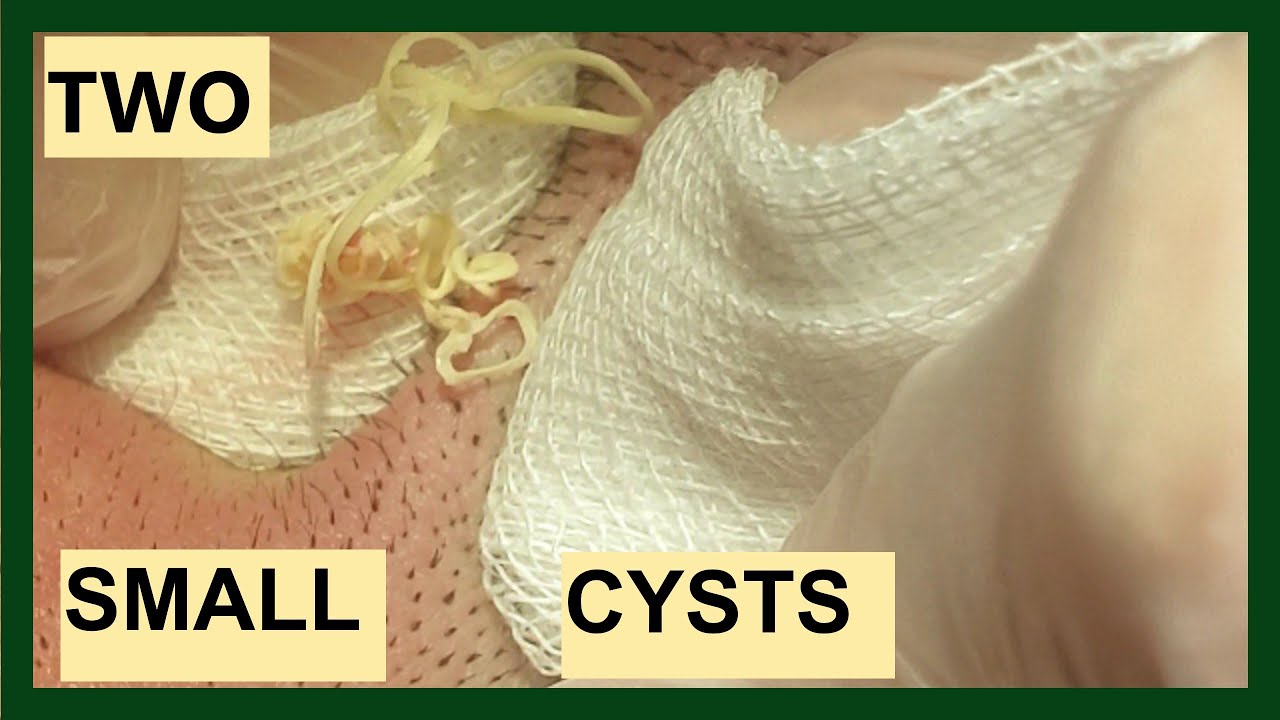 CYSTS REMOVAL - (With CAPSULES)