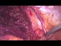 Laparoscopic Bilateral Redo TAPP Mesh Repair