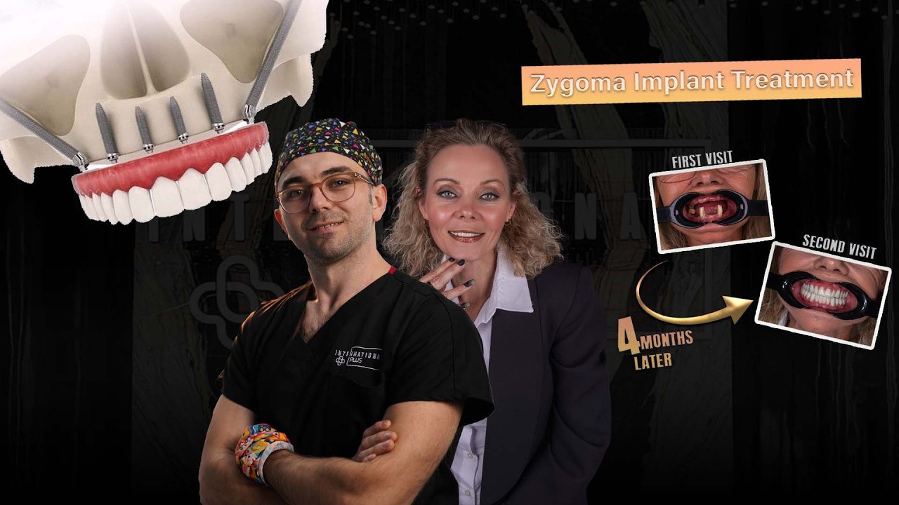 Zygoma Implant Treatment at International Plus YouTube