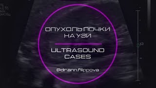 ОПУХОЛЬ ПОЧКИ на УЗИ 🎞️ Ультразвуковая диагностика ⚠️ Кidney cancer 🔍 ULTRASOUND CASES