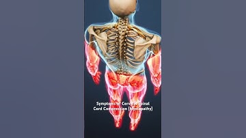 Symptoms of Cervical Spinal Cord Compression (Myelopathy)