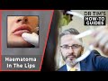 How To Diagnose, Manage & Avoid A Haematoma In The Lips