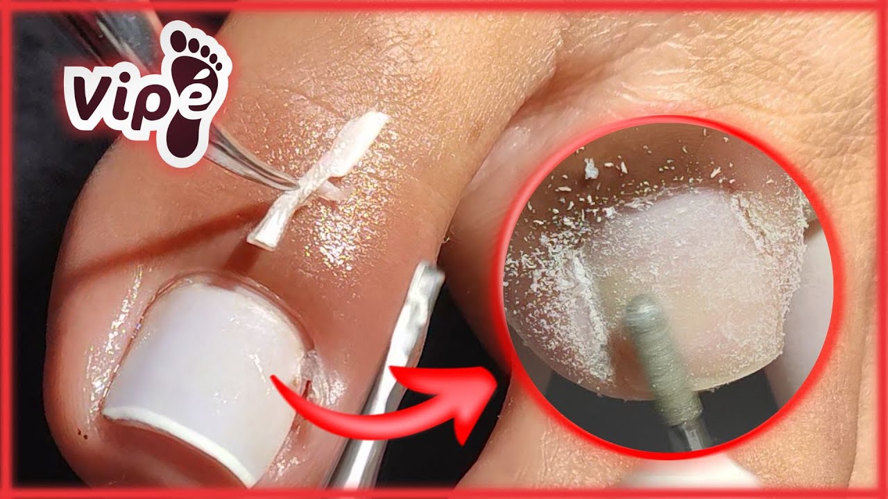 OVERGROWN INFECTED INGROWN TOENAIL REMOVAL YouTube